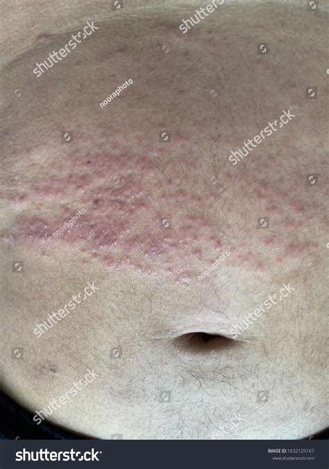 Atopic Dermatitis Skin Rashes On Abdomen Stock Photo 1632125167 ...