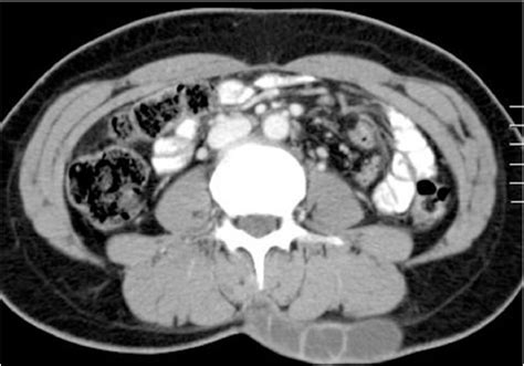 ULTRASONOGRAPHIC OR CT FINDINGS OF EPIDERMAL CYSTS IN THE TRUNK: CORRELATION WITH SURGICAL ...