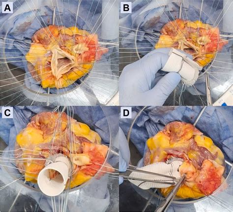 Novel Valve Sparing Aortic Root Replacement Device: Between a David and a Yacoub - Seminars in ...