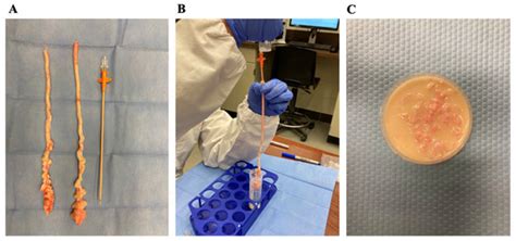 Retrograde Flushing Followed by Slicing Float-Up as an Approach to ...