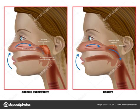 Adenoid hypertrophy, the abnormal growth of the pharyngeal tonsils. Adenoidectomy. Eustachian ...