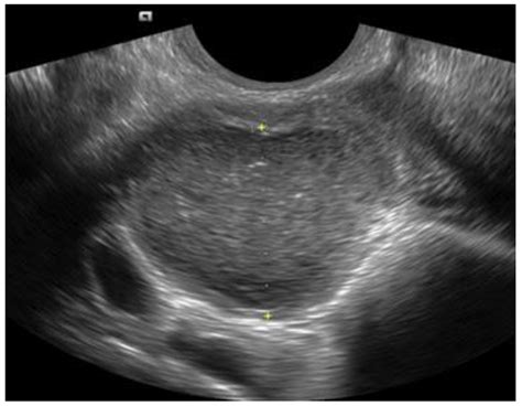 Transvaginal Ultrasound in the Diagnosis and Assessment of Endometriosis—An Overview: How, Why ...