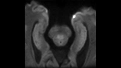 Philips - Zoom Diffusion MR clinical application