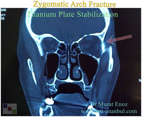 Zygomatic Arch Anatomy, Fracture, and Titanium Plate Stabilization