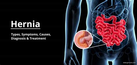 Hernia: Types, Symptoms, Causes, Diagnosis & Treatment – Grocare® India