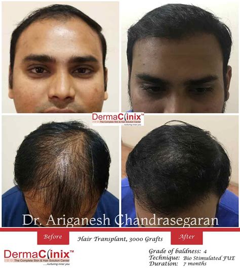 Best Hair Transplant Clinic in Chennai, Hair transplant Center
