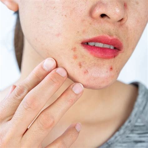 Image result for Exploding Face Zits