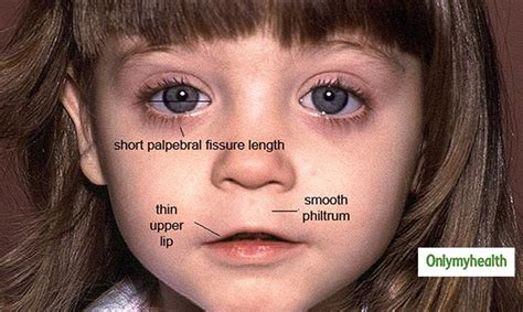 Fetal Alcohol Syndrome Causes, Symptoms and Side Effects of Drinking ...