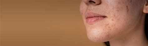 Pigmentation Treatment at Skin Secrets Kochi