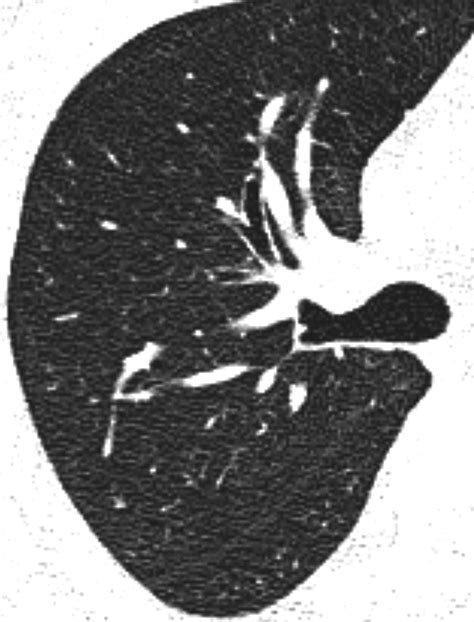 Ground-Glass Nodules on Chest CT as Imaging Biomarkers in the ...