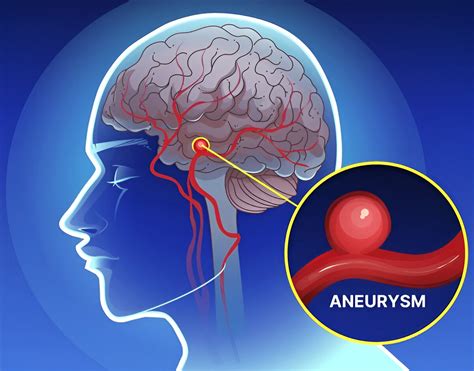 Early Warning Signs Of Brain Aneurysm: What It Is, Why It Happens, And ...