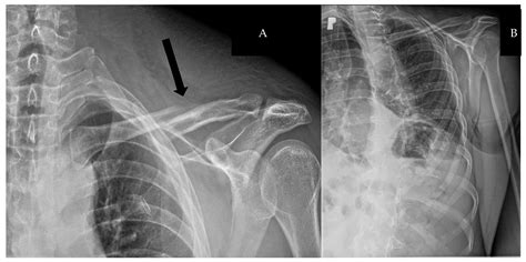 Post-Traumatic Left Subclavian Artery Pseudoaneurysm Secondary to ...