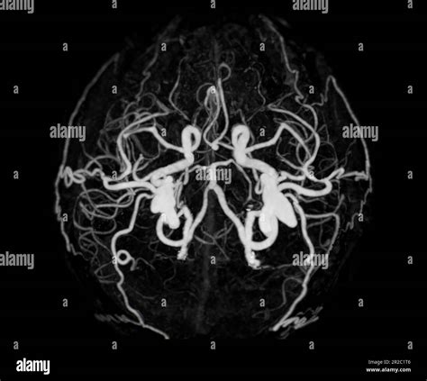 CT angiography of the brain or CTA brain showing Cerebral artery Stock ...