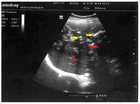 Sonographic Images of Hepatic Portal Venous Gas in a Patient with Gastrointestinal Ischemia