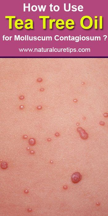 Image result for tea tree oil warts