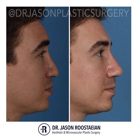 Nose Job Before And After Men Male Rhinoplasty Before And After