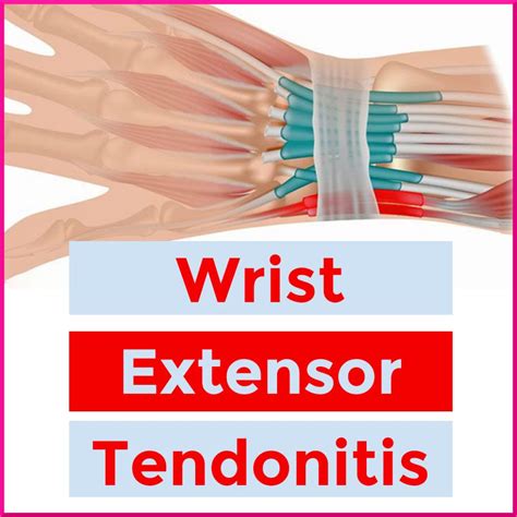 Review of Extensor Carpi Ulnaris Tendinopathy - Sports Medicine Review