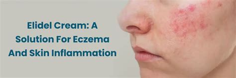 Elidel Cream: Uses, Dosage and Side Effects for Eczema