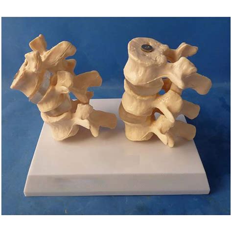 Buy GAOF Diseased Lumbar Comparison Model - Human Lumbar Model - The ...