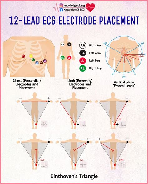 Ecg electrode placement – Artofit