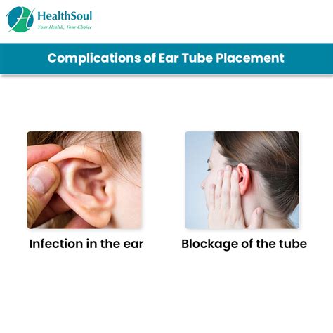 Ear Tube Procedure For Babies at Gilberto Morales blog