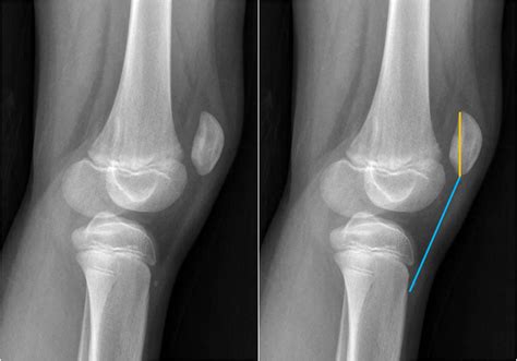 Patellofemoral instability: anatomical risk factors | Eurorad