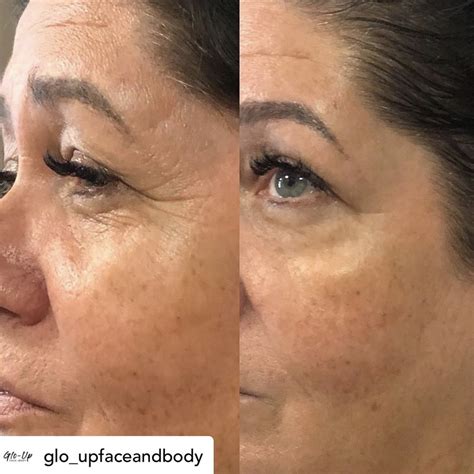 Before & After | Advanced Microcurrent Science for Anti-Aging