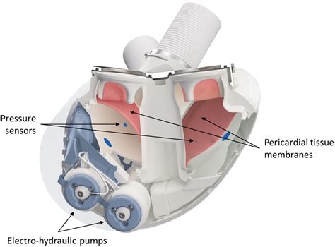 The First Autoregulated Total Artificial Heart Implant in the United States - Annals of Thoracic ...