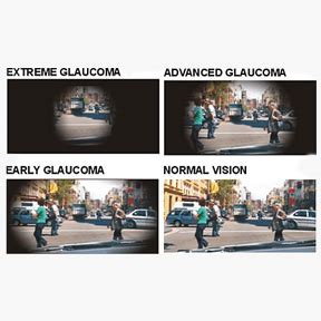 Glaucoma :: CL Gupta Eye Institute