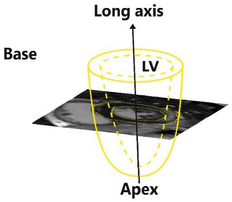 The Influence of Late Gadolinium Enhancement Cardiac Magnetic Resonance ...