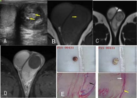 Imaging in testicular epidermoid cysts - Clinical Imaging