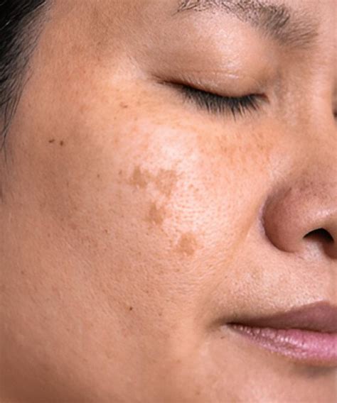 Sensitive Skin Care Products Online at Best Price in India – Awear Beauty