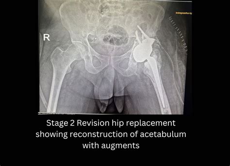 Bone and Joint Infections Treatment in Delhi | Dr. Yashwant Singh Tanwar