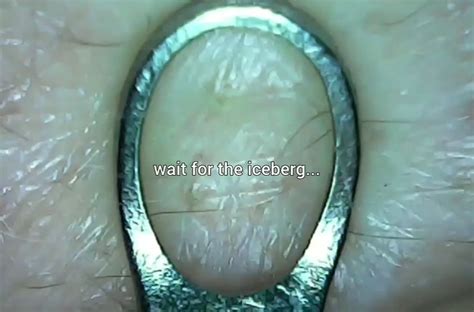 Image result for Back Full of Exploding Cysts