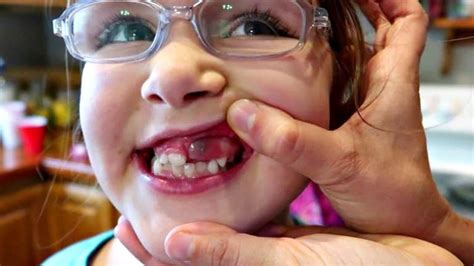 Epic Exploding Cysts 的图像结果