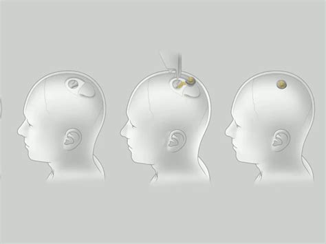 Elon Musk's Telepathic Brain Chip 'Neuralink' Could See First Human ...