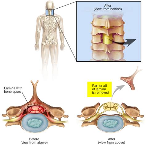 How Long Does A Laminectomy With Fusion Take at Cory King blog