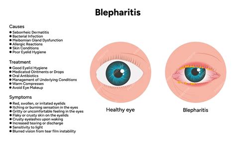 Premium Vector | Blepharitis eye disease Ophthalmology Inflamed sick ...