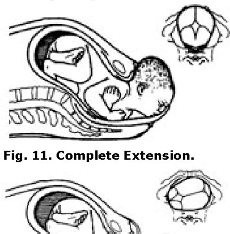 Image result for Common Compensatory Pattern