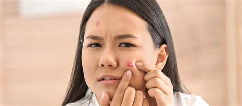 Blind Pimple: Its Causes And Treatment – Re'equil