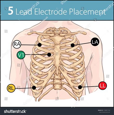 Cardiac 5 Lead Placement