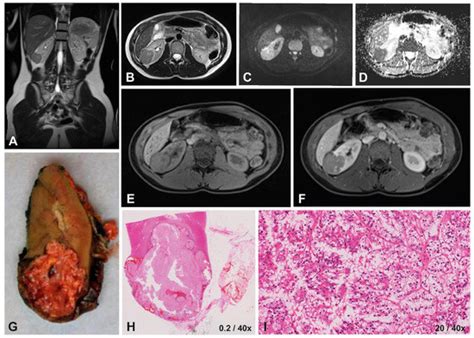 MRI Characteristics of Pediatric and Young-Adult Renal Cell Carcinoma ...