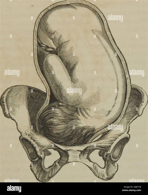 Occiput anterior presentation hi-res stock photography and images - Alamy