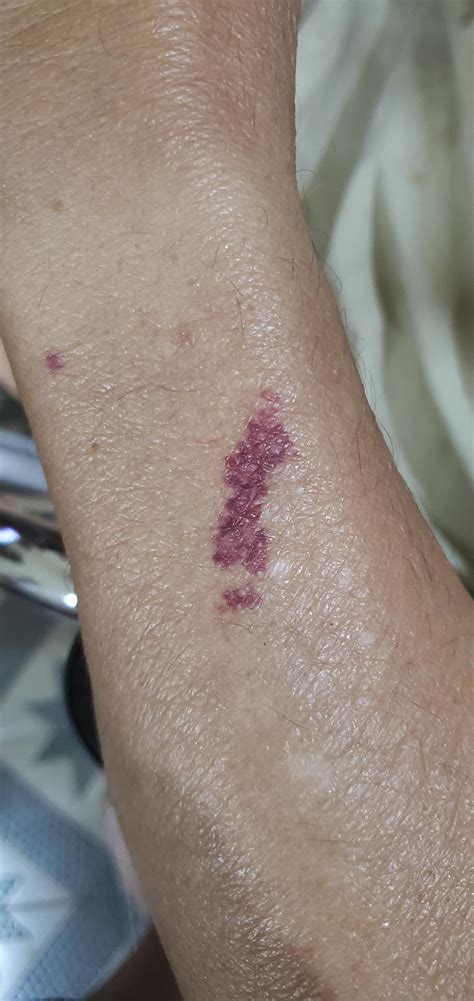 Red spots on arms of 77 year old male : r/DiagnoseMe