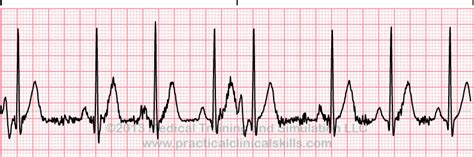 Image result for Synchronized Cardioversion EKG Strips Practice