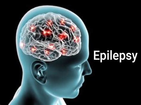 National Epilepsy Day 2020 India: जानिए नर्वस सिस्टम डिसऑर्डर से जुड़ी ...