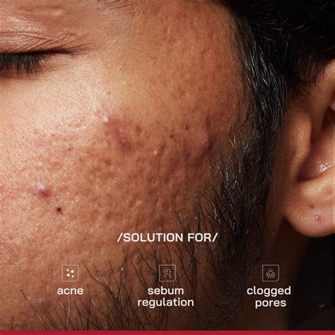 Buy Proven Honest Derma (PHD) 2% Salicylic Acid Anti-Acne Serum Online