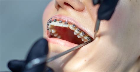 When Were Braces Invented? A Complete History of Braces | Frey Orthodontics
