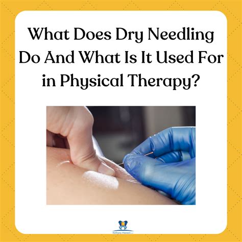 What Does Dry Needling Do and What Is It Used For In Physical Therapy? — Bethany's Hansen, LLC