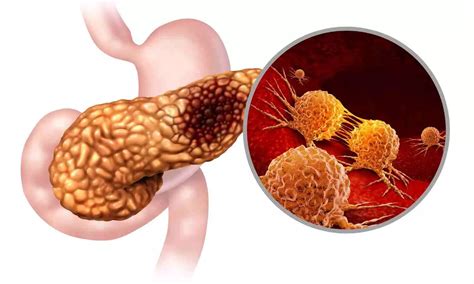 Chat GPT may prouce structured, summarized radiology reports for ...